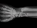 Spiel Arm surgery